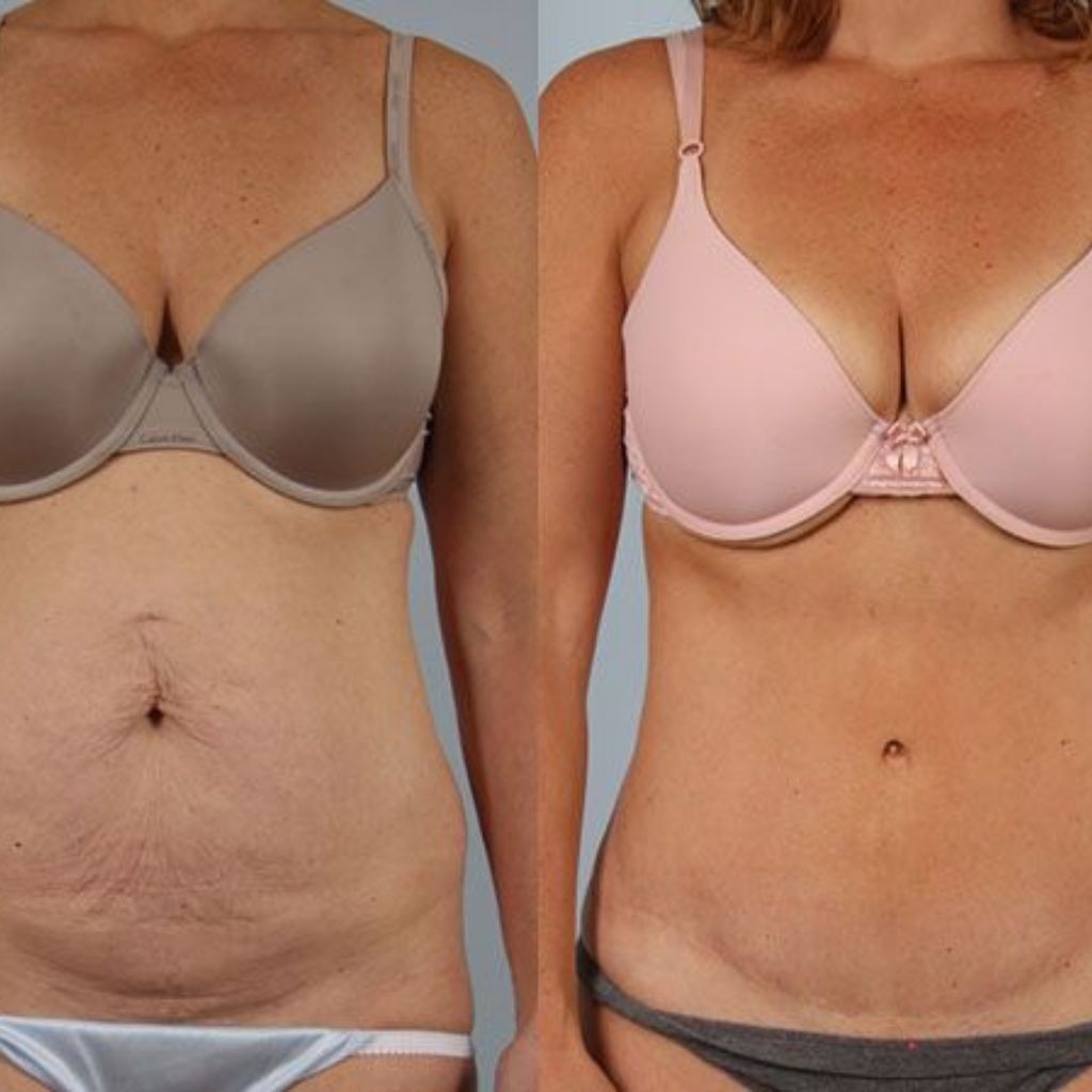 Before and after on the stomach